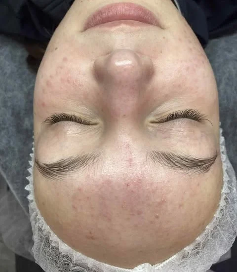 Przed terapią łączoną